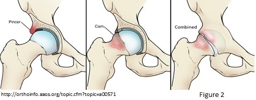 Femoroacetabular Impingement, FAI, Portland Physical Therapy, Physical Therapy